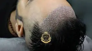 Turkey Hair Transplant: Everything You Need to Know Before Making the Move Turkey Hair Transplant