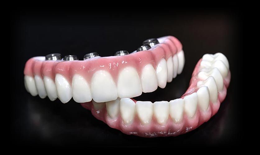 Are Full-Arch Implants Better Than Dentures? dental implants north york 1