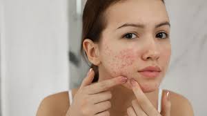 Why Acne Skin Skincare Feels Frustrating (And What Actually Starts to Help) download 2026 05 21T224445.283