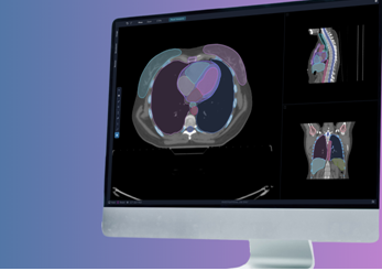 Benefits of AI contouring for radiation oncology departments image 1080