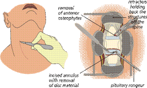 Surgery Options for Multilevel Cervical Myelopathy: What Research Shows image 5033